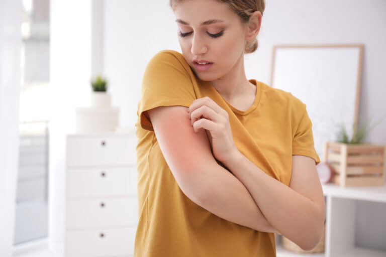 woman scratching arm that is red from urticaria and allergies