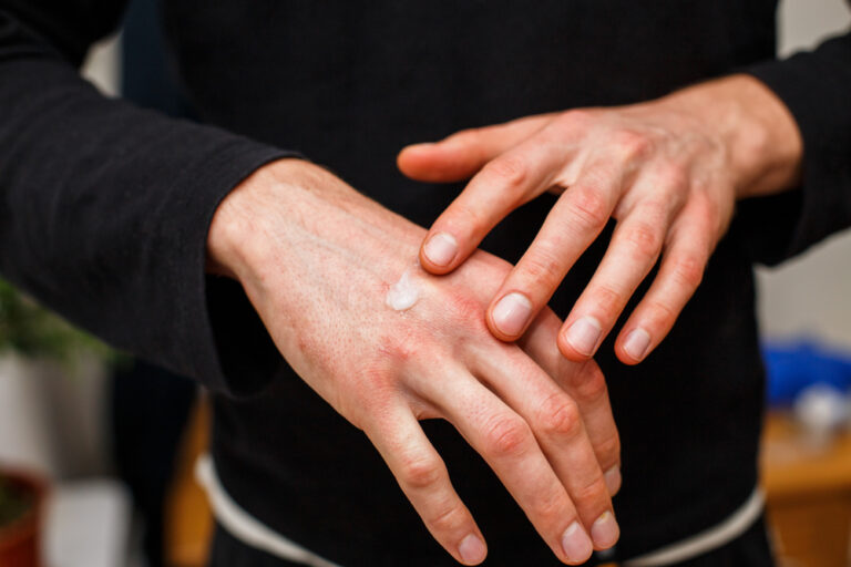 man with eczema on hands applying betaderm steroid cream